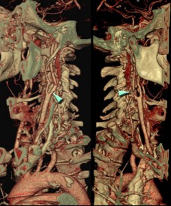 angiografia_arterias_cervicales