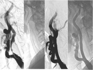 angioplastia_colocacion_stent